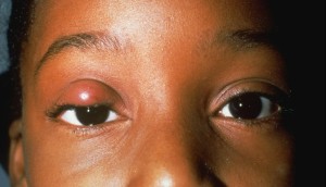 A photograph of a patient with a chalazion