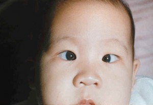 A young patient prior to being treated for strabismus.